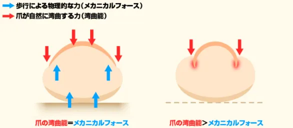 巻き爪補正